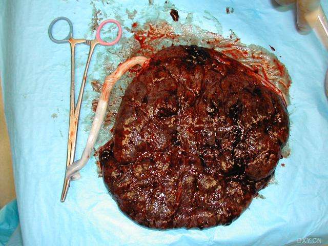 剖宫产真实图片2 - 好大夫在线