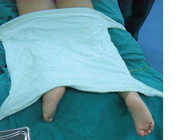脊柱裂婴儿图片