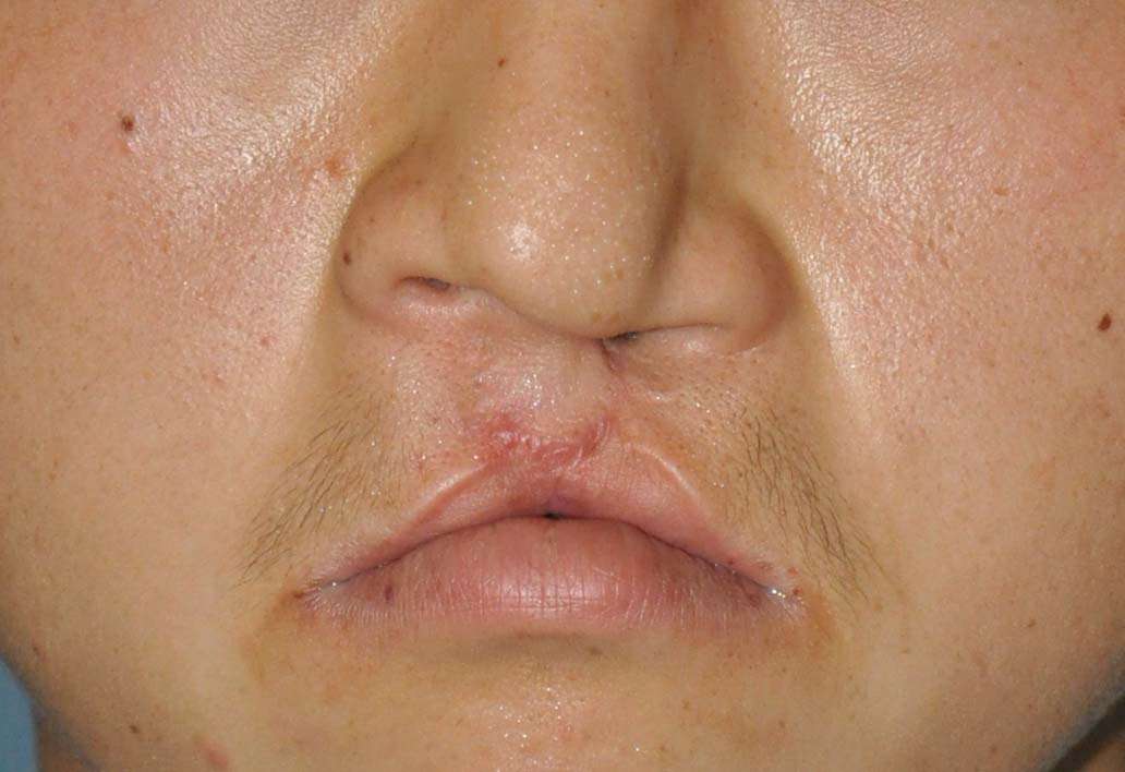 唇裂二期鼻唇畸形手术修复 - 好大夫在线