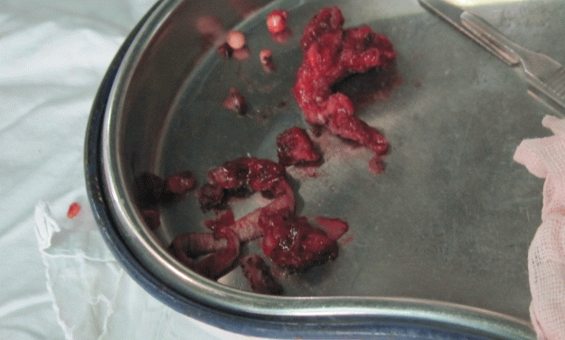 蔓状血管瘤 - 好大夫在线