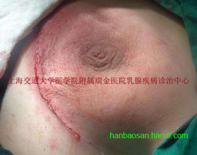 乳腺导管瘤的真人图片图片