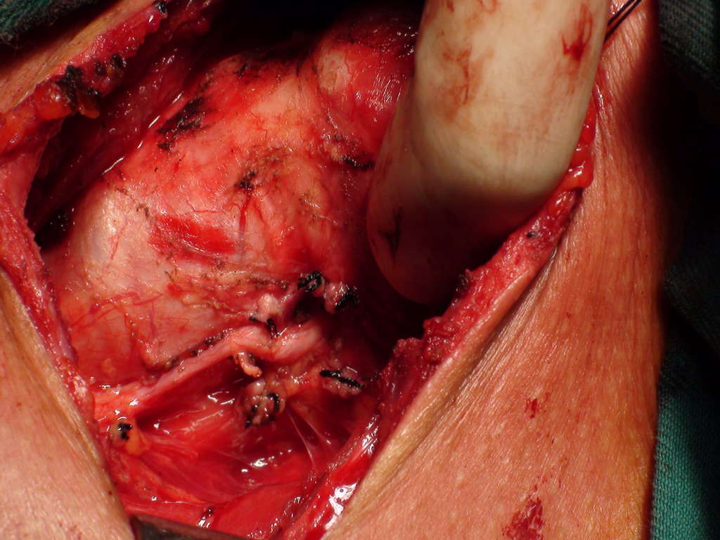 甲状腺结节手术喉返神经显露