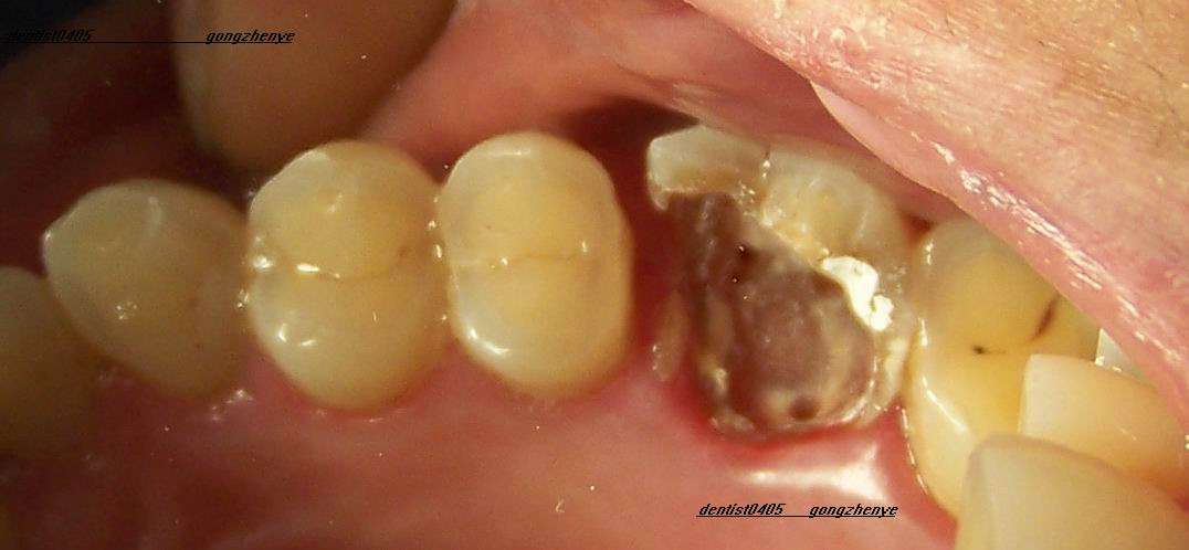 上颌第一磨牙在就诊时要注意