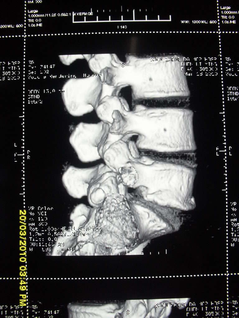 腰椎滑脱图片x线诊断图片