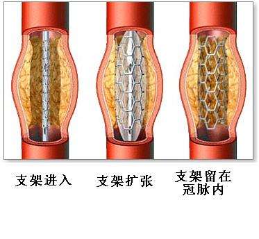 冠脈介入心臟支架術手術過程簡圖