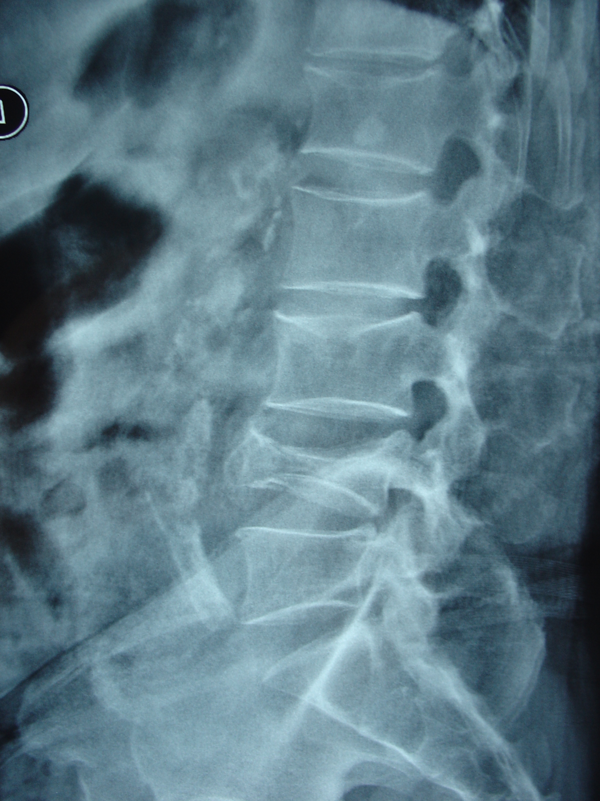 骨质疏松性椎体压缩性骨折——经皮球囊扩张椎体后凸成形术(pkp) 