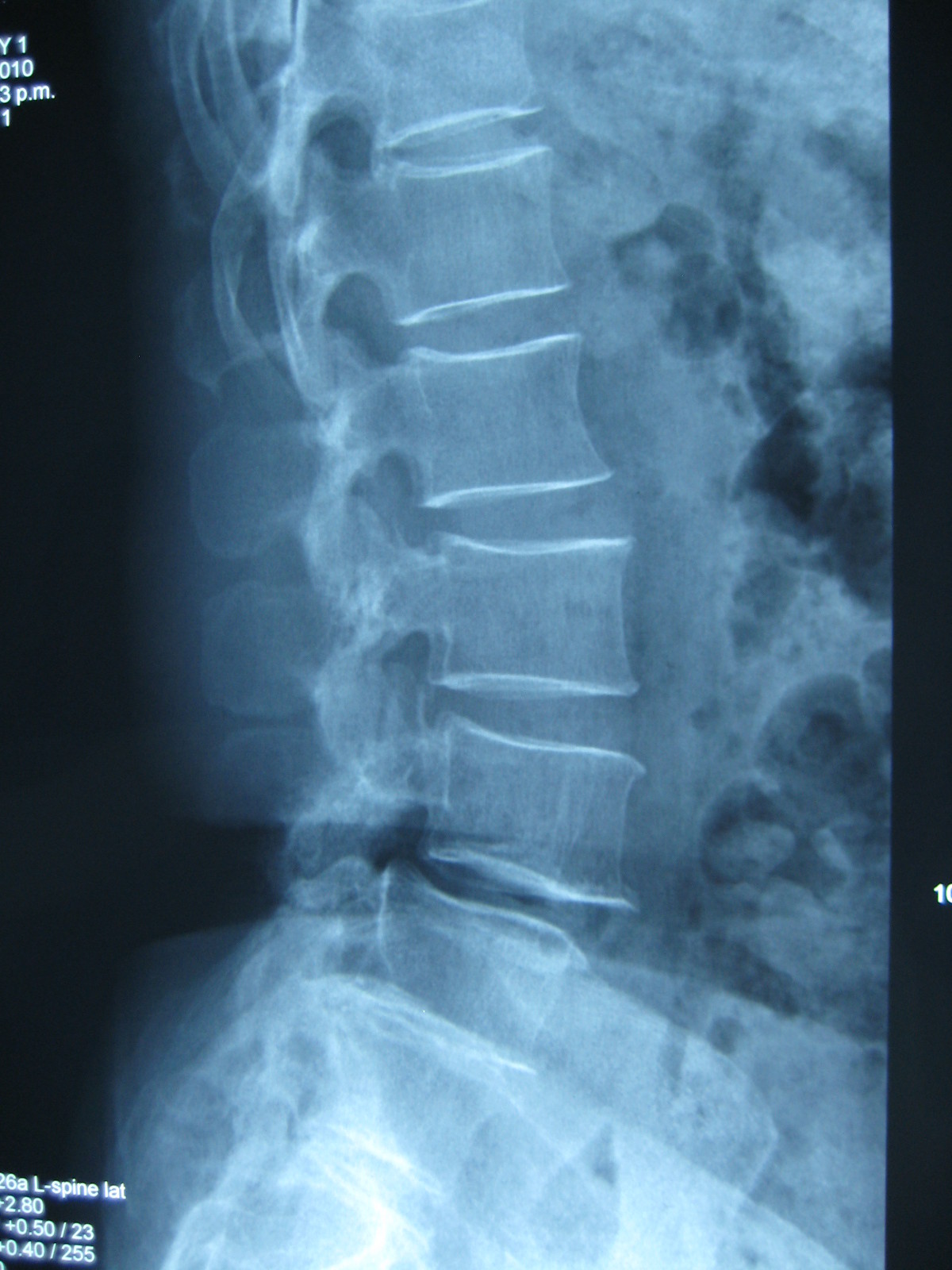 腰椎间盘突出症术后腰椎退变滑脱 - 好大夫在线