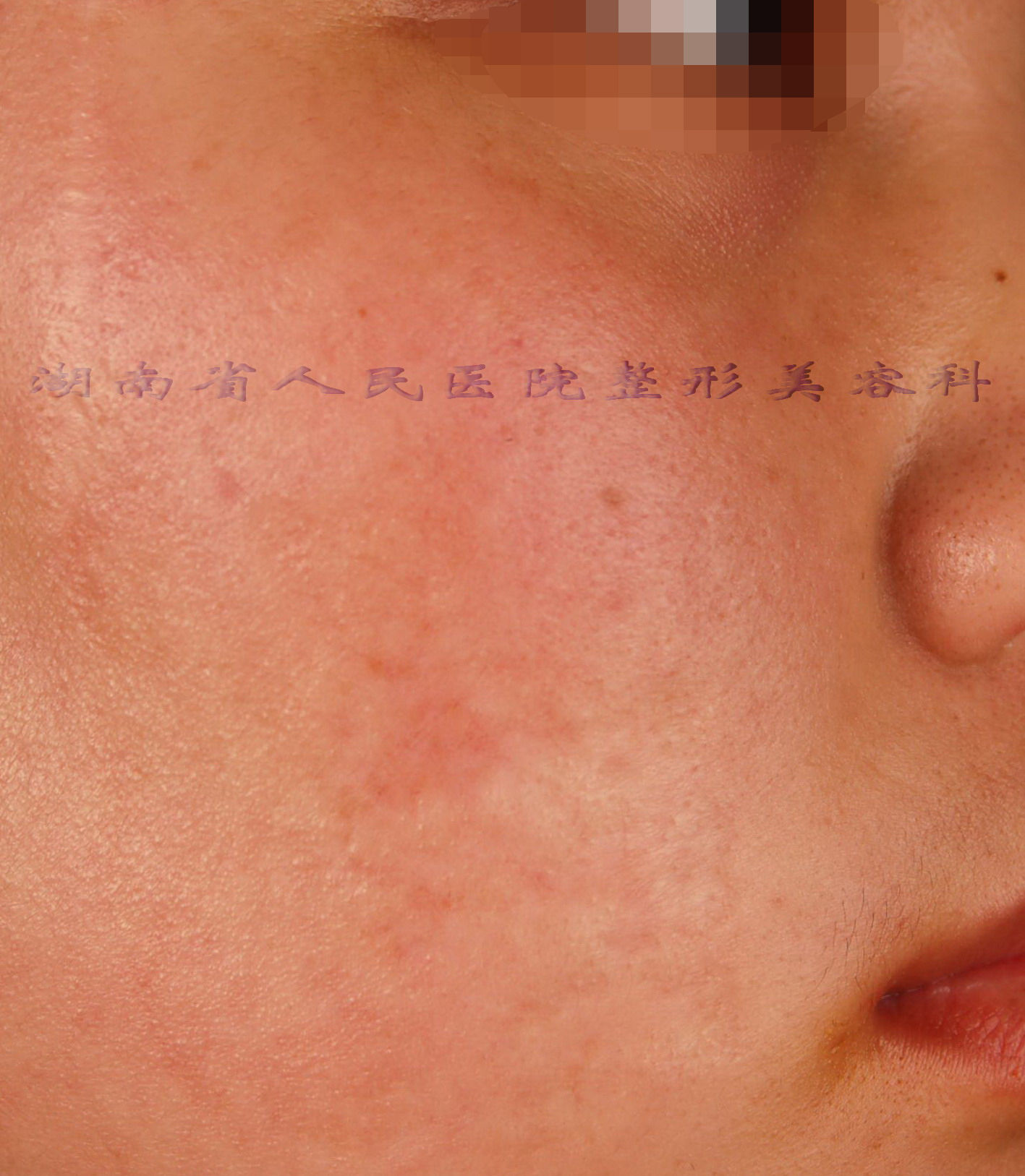 扁平疤痕的点阵激光再生修复4 - 好大夫在线