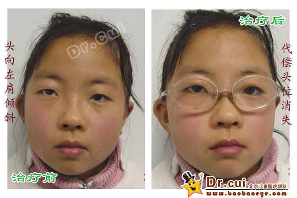 麻痹性斜视,歪头视物,头向右肩倾斜,戴三棱镜矫正后头位改正,斜视矫正