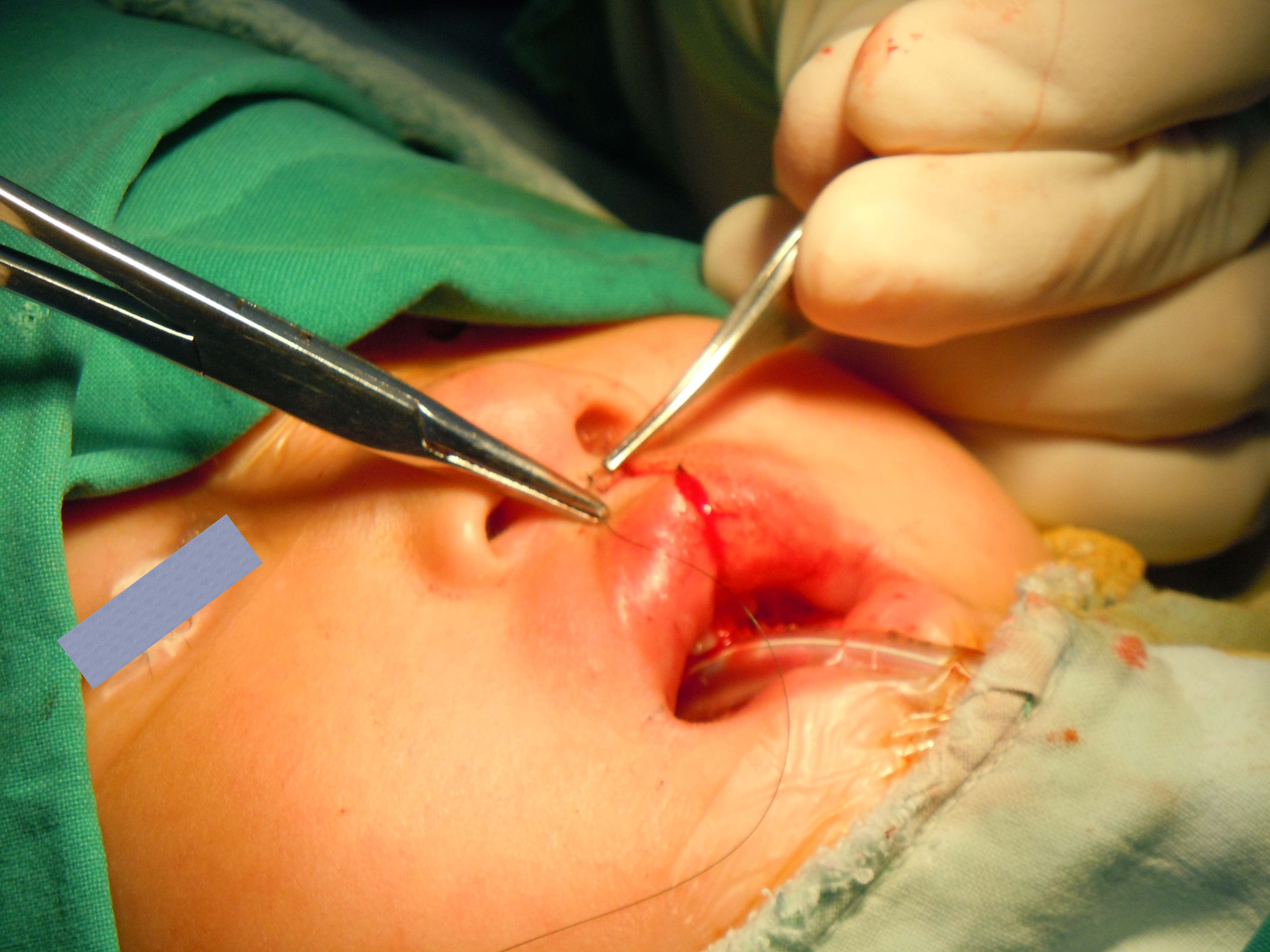 隐隐约约的缺憾-唇隐裂_唇腭裂_手术_治疗方式 - 好大夫在线