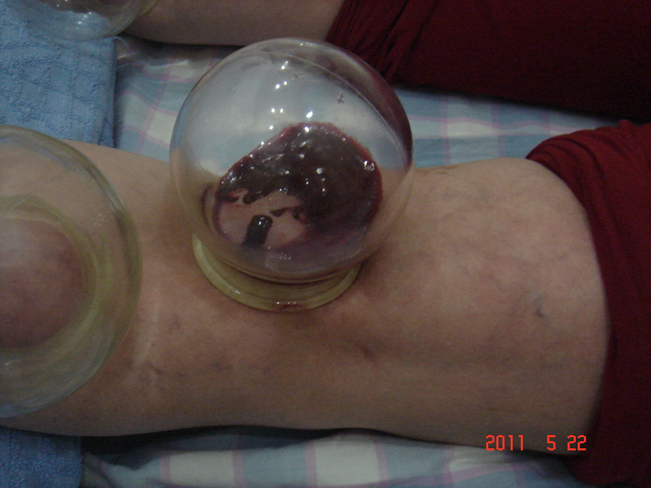 膝盖放血的位置图片图片