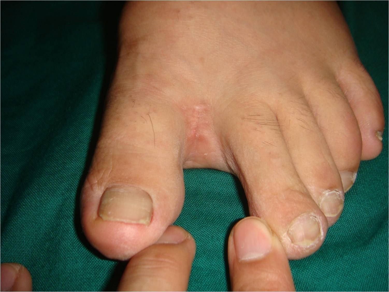 拇外翻术前术后对比 - 好大夫在线