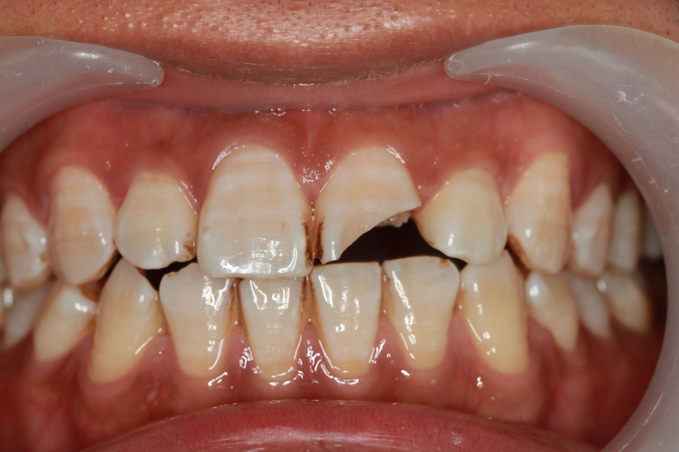 病例一:四环素牙的特殊染色 - 好大夫在线