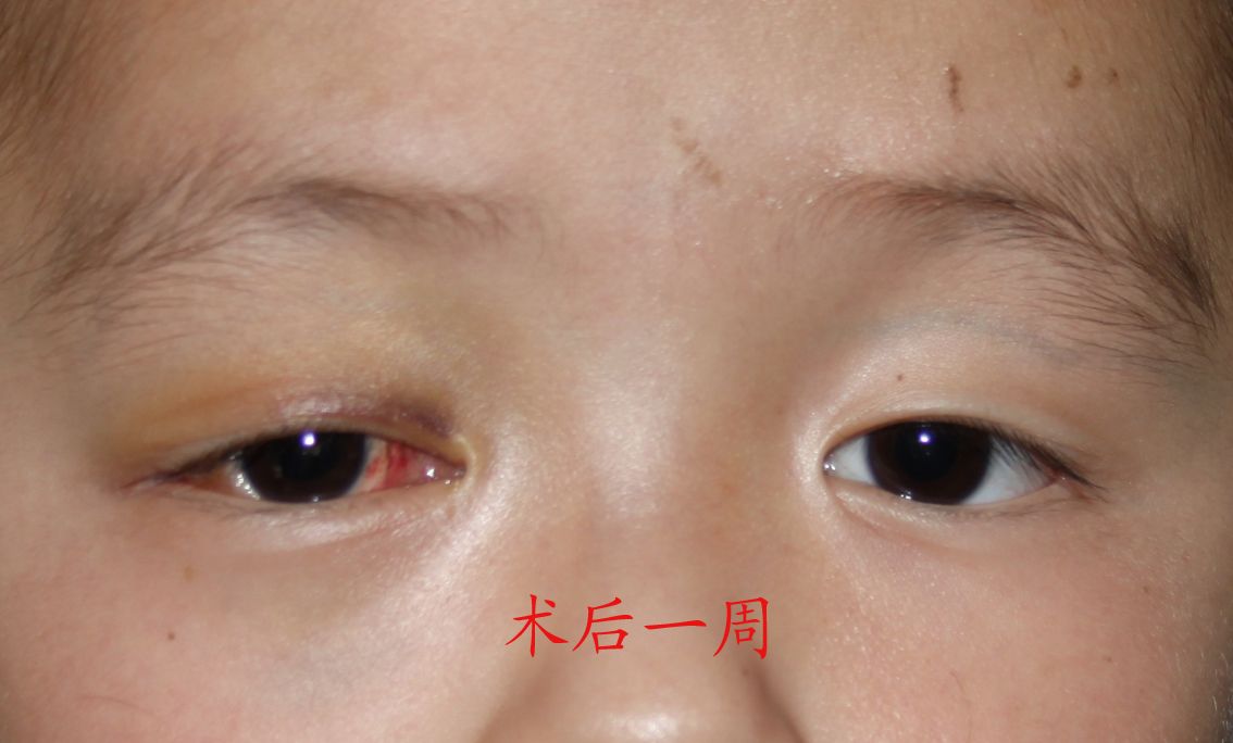 眼眶静脉性血管瘤 - 好大夫在线