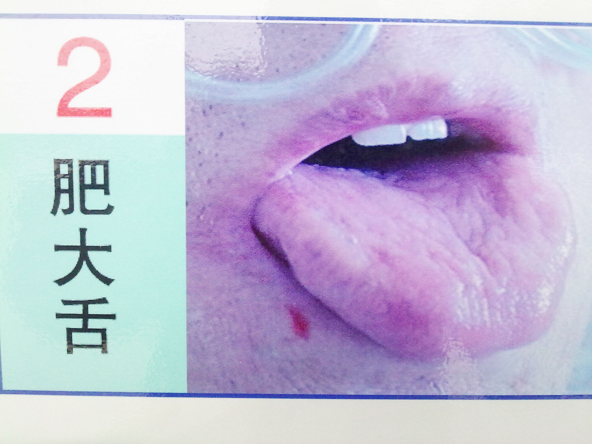 舌部表面病变的表现一(图) - 好大夫在线