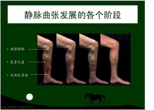 大隱或小隱靜脈高位結紮及主幹與曲張靜脈剝脫術