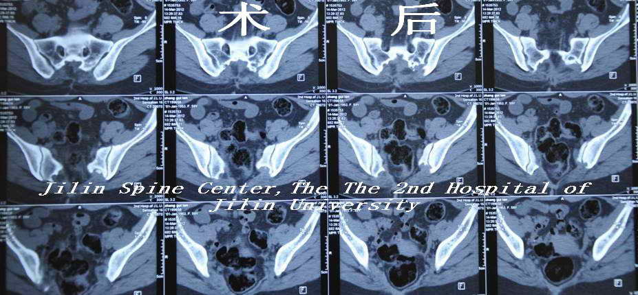 骶骨骨鉅細胞瘤術後一年半沒有復發