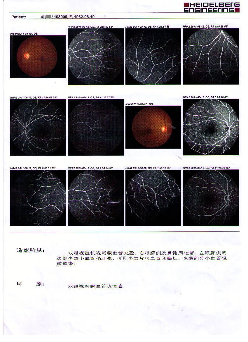 霜枝樣視網膜血管炎典型病例眼底熒光造影