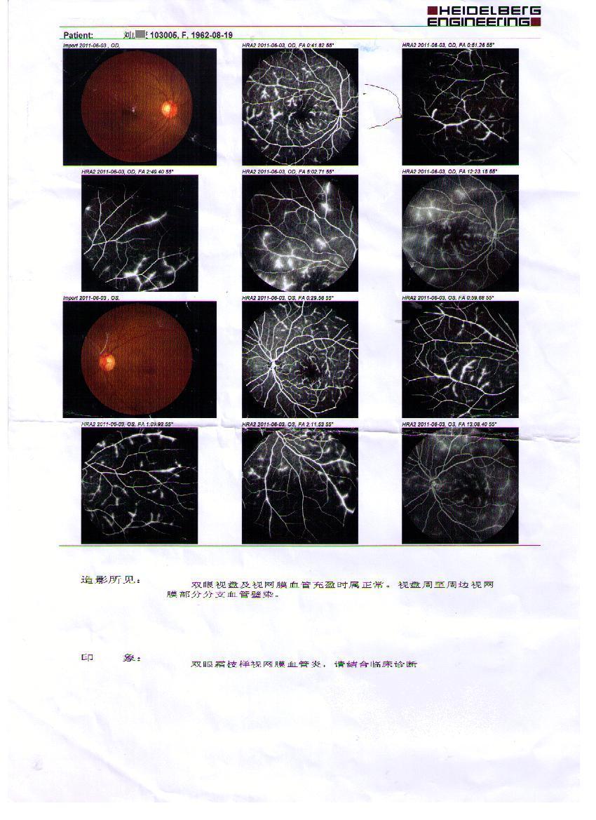 霜枝样视网膜血管炎 典型病例 眼底荧光造影 - 好大夫在线