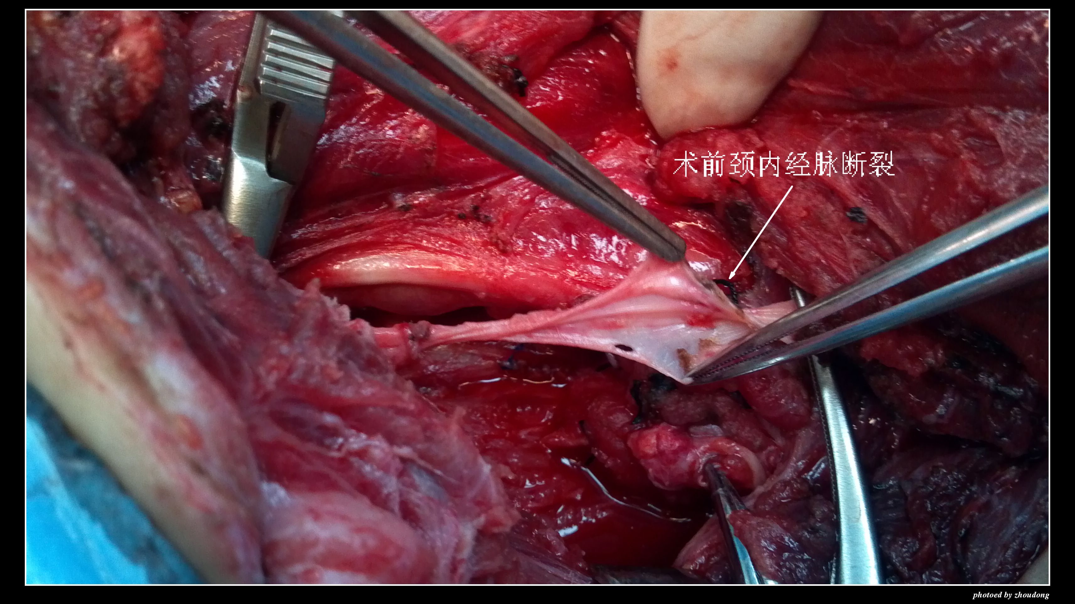 为生命搭建绿色通道---记兰大二院血管外科抢救颈部刀刺伤并大出血