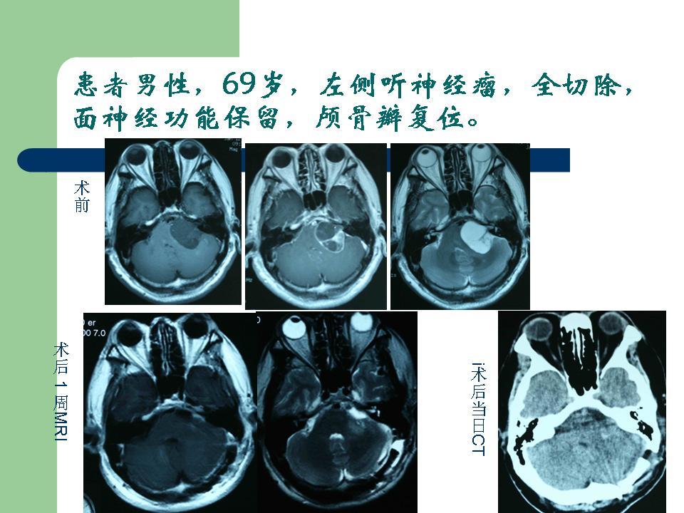 老年聽神經瘤也可以做到全切除腫瘤同時保留面神經功能 - 好大夫在線