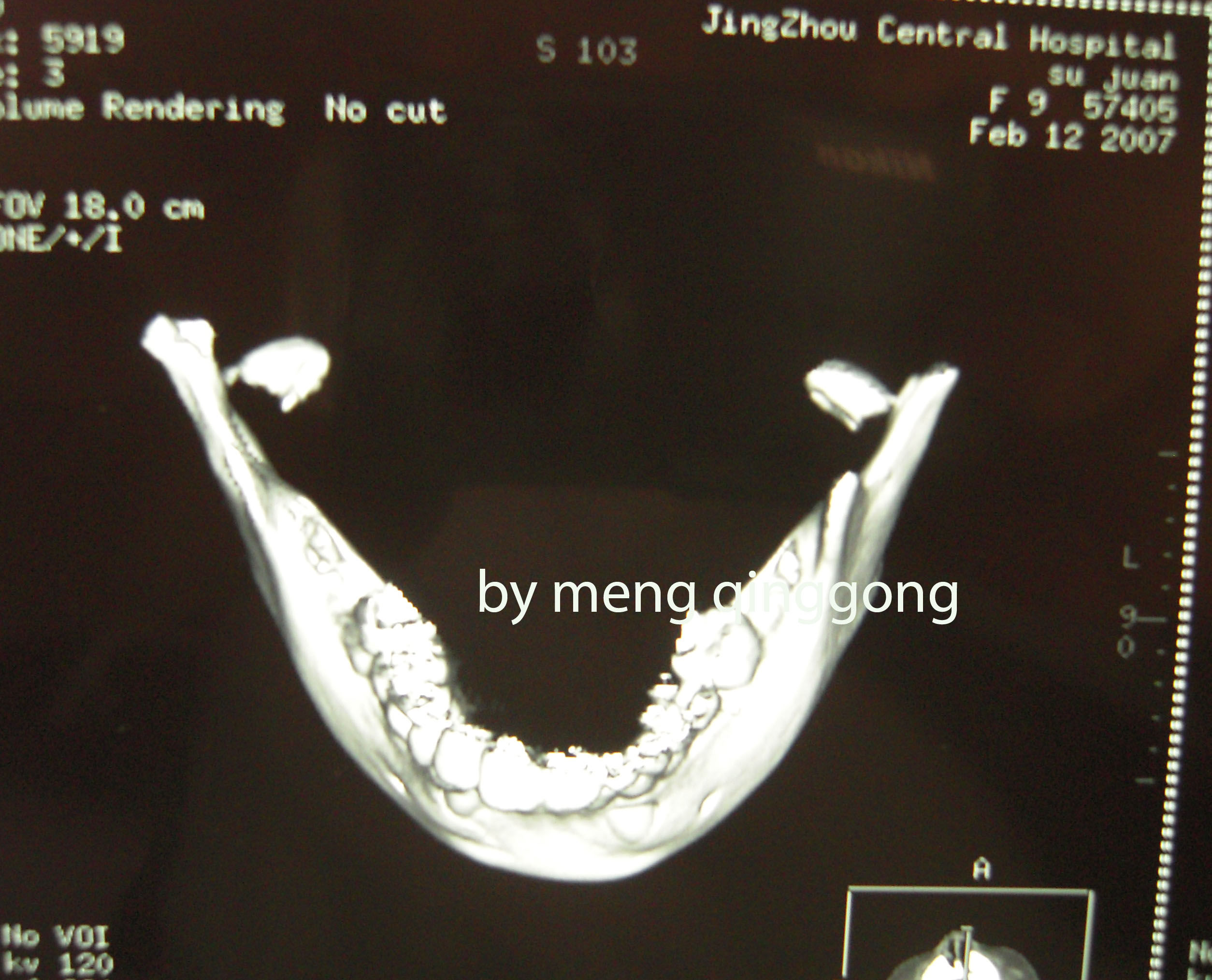 颞下颌髁突骨折术后发生关节强直,喙突移植重建髁突(有图片) 