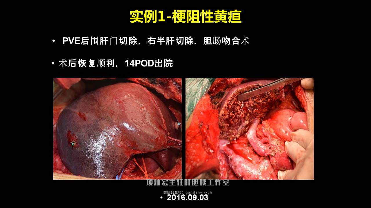 結論圍肝門切除聯合三肝葉切除可以提高患者的r0切除