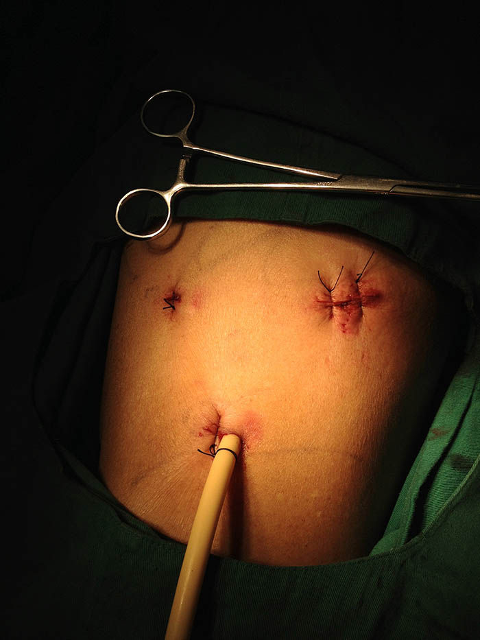 病例分享-全腹腔镜下左肾输尿管全长,膀胱根治性切除术 右侧输尿管