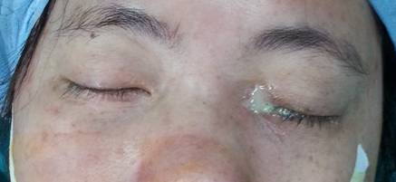 经鼻腔内镜下泪囊鼻腔吻合术的若干问题(图)_泪道阻塞_手术_治疗方式