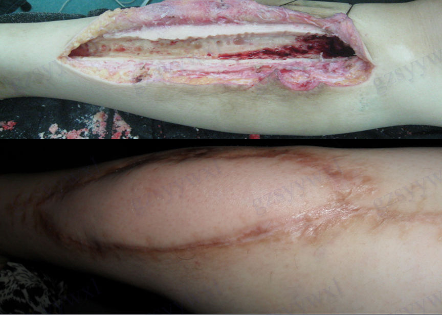 骨髓炎治疗 - 好大夫在线