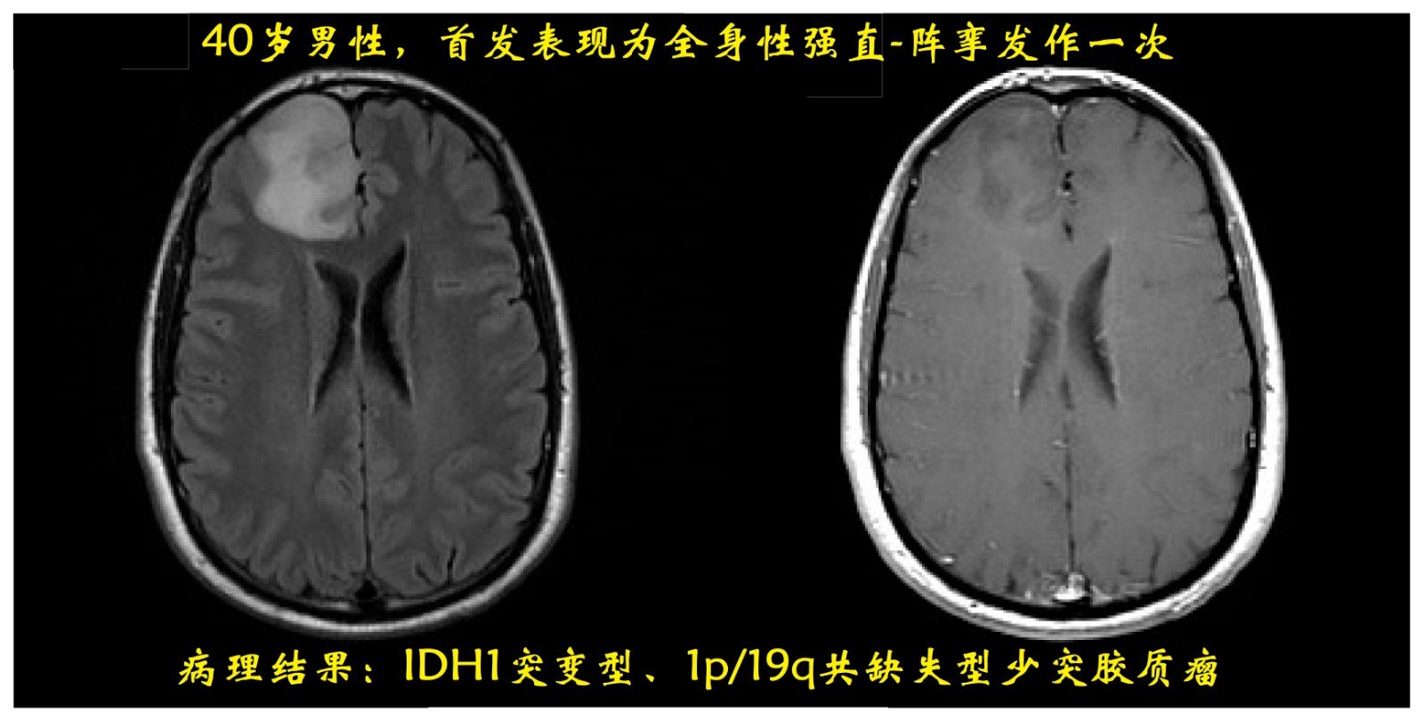 包含"idh和"1p/19q 共缺失" 的"少突胶质瘤"