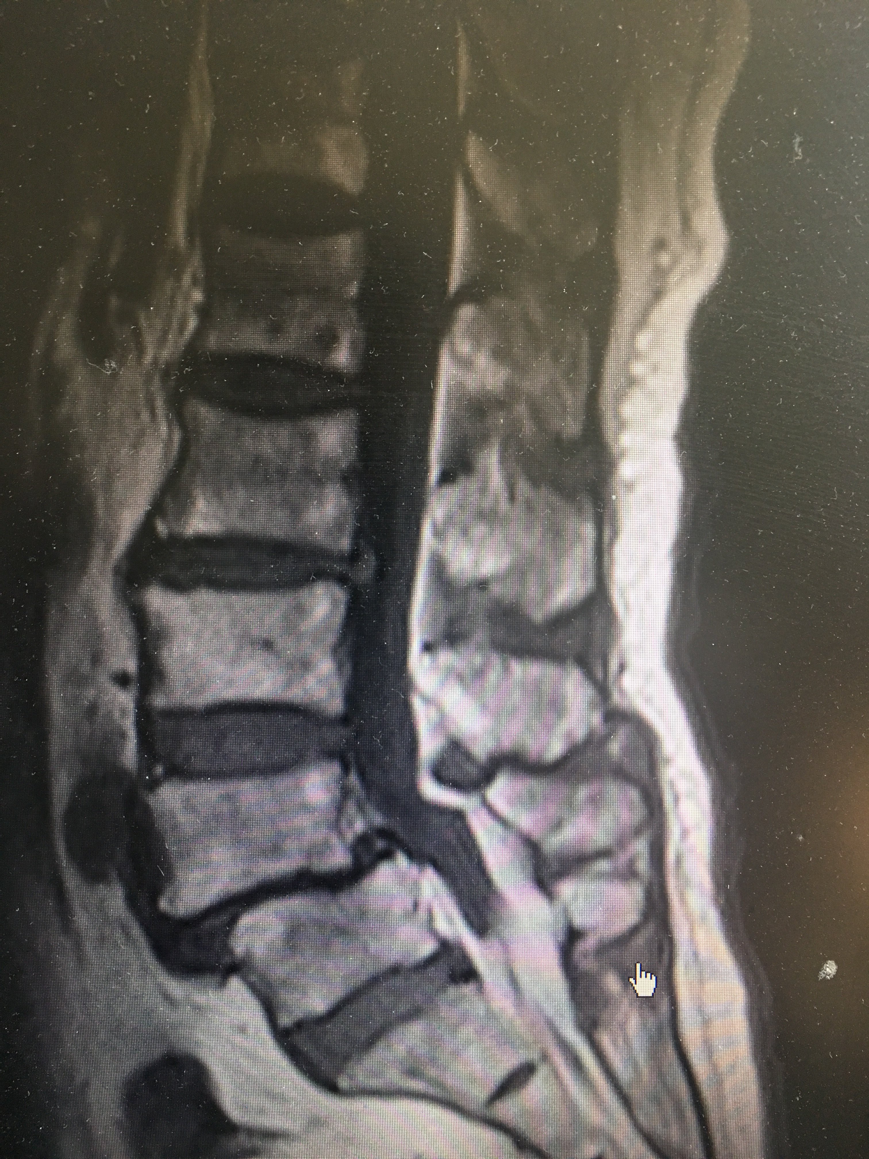 周围高信号挤成了一条线矢状位核磁,看到患者并没有明显腰椎间盘突出