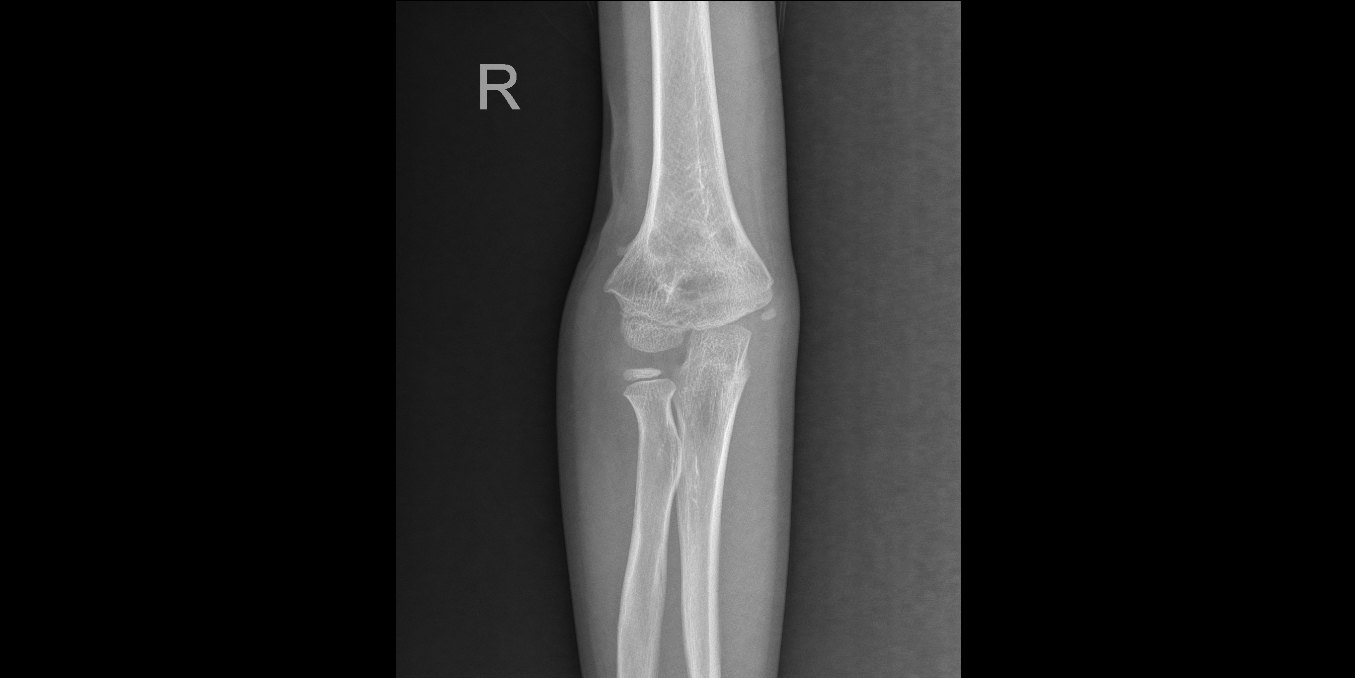 病例分享 | 肘内翻 - 好大夫在线