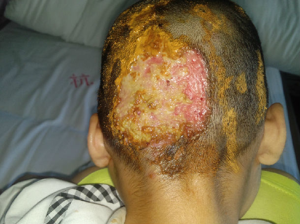 (图片是头部脓癣)得了头皮细菌 感染 也不要慌张,要及时就医治疗.