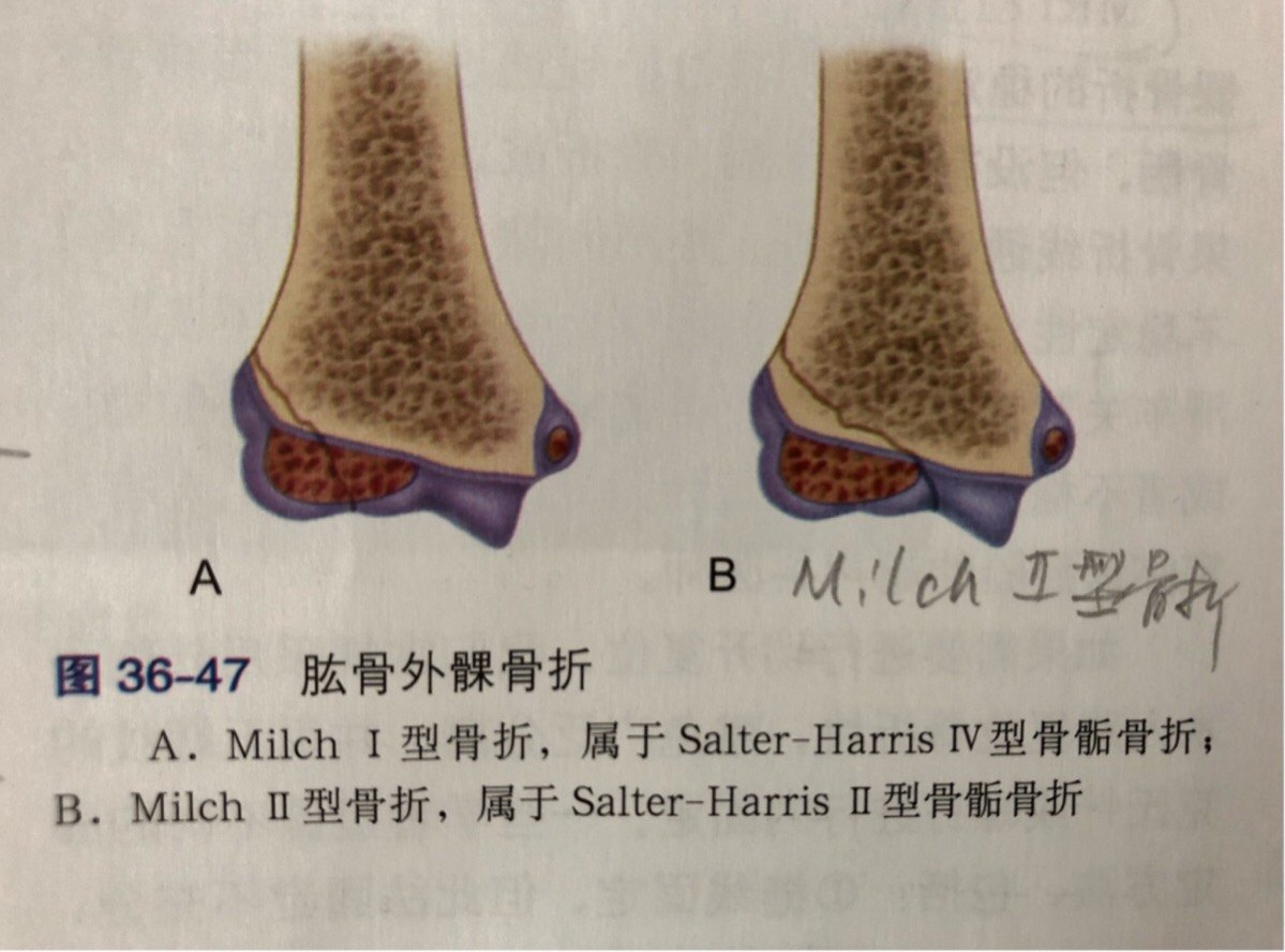 肱骨外髁骨折 www.haodf.com