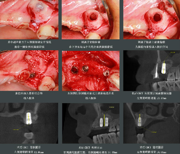 多數牙先天缺失伴骨量嚴重不足的種植修復