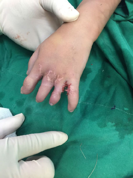 > [转]多指(趾)并指(趾)复合畸形案例