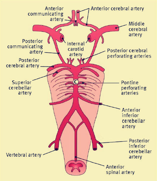 后循环缺血性卒中