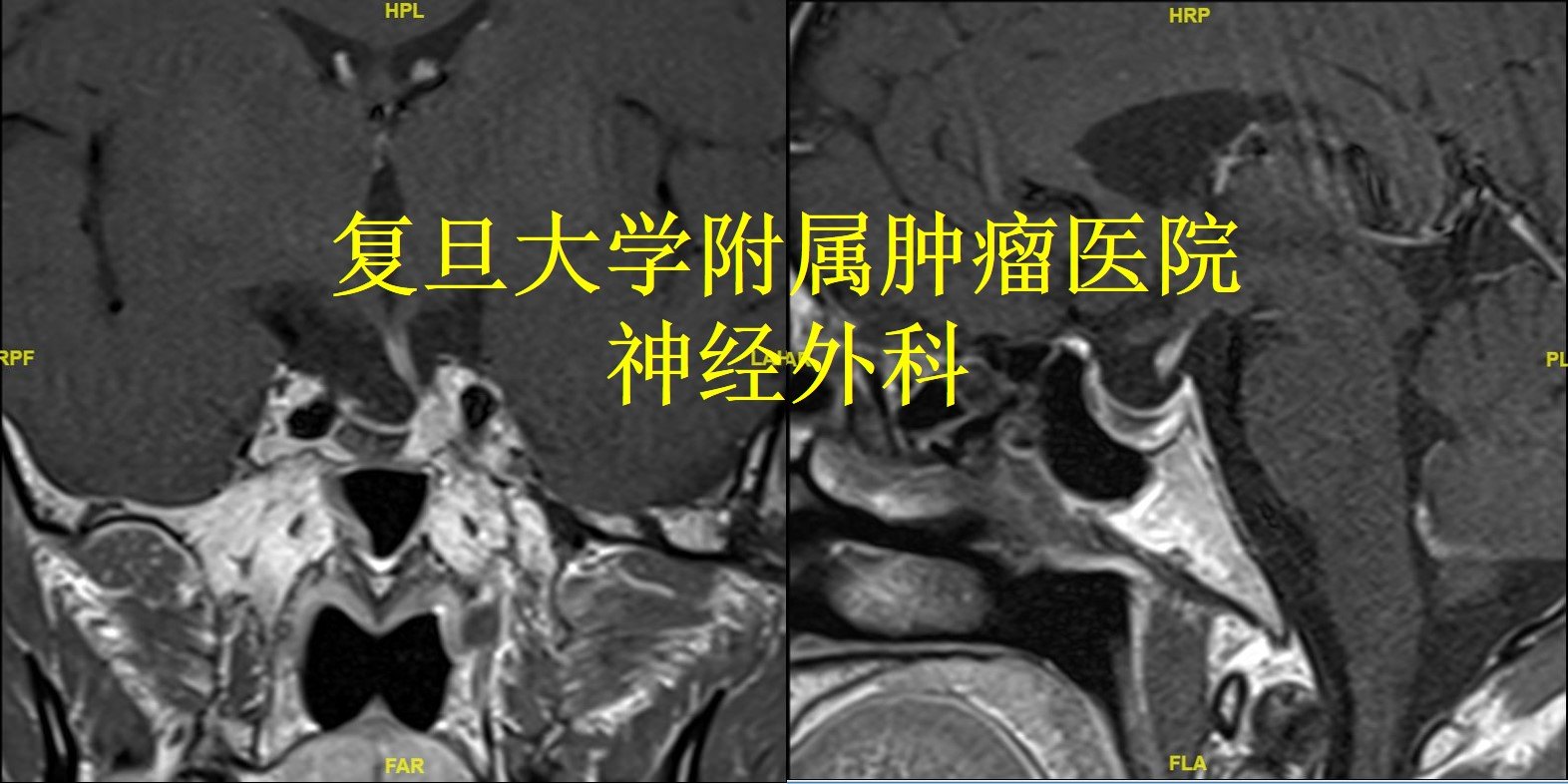 經鼻微創手術切除垂體瘤