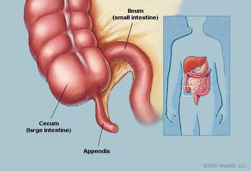 阑尾炎的解剖位置图片图片