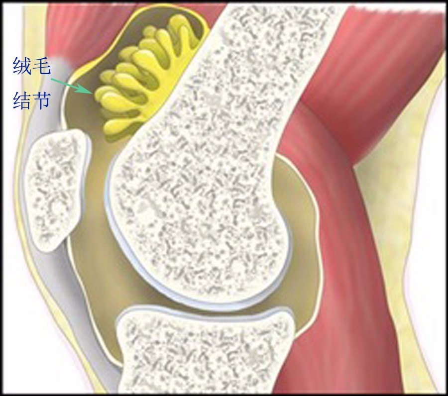 膝关节滑膜皱襞综合症膝关节滑膜皱襞反复受到损伤或刺激,可使滑膜