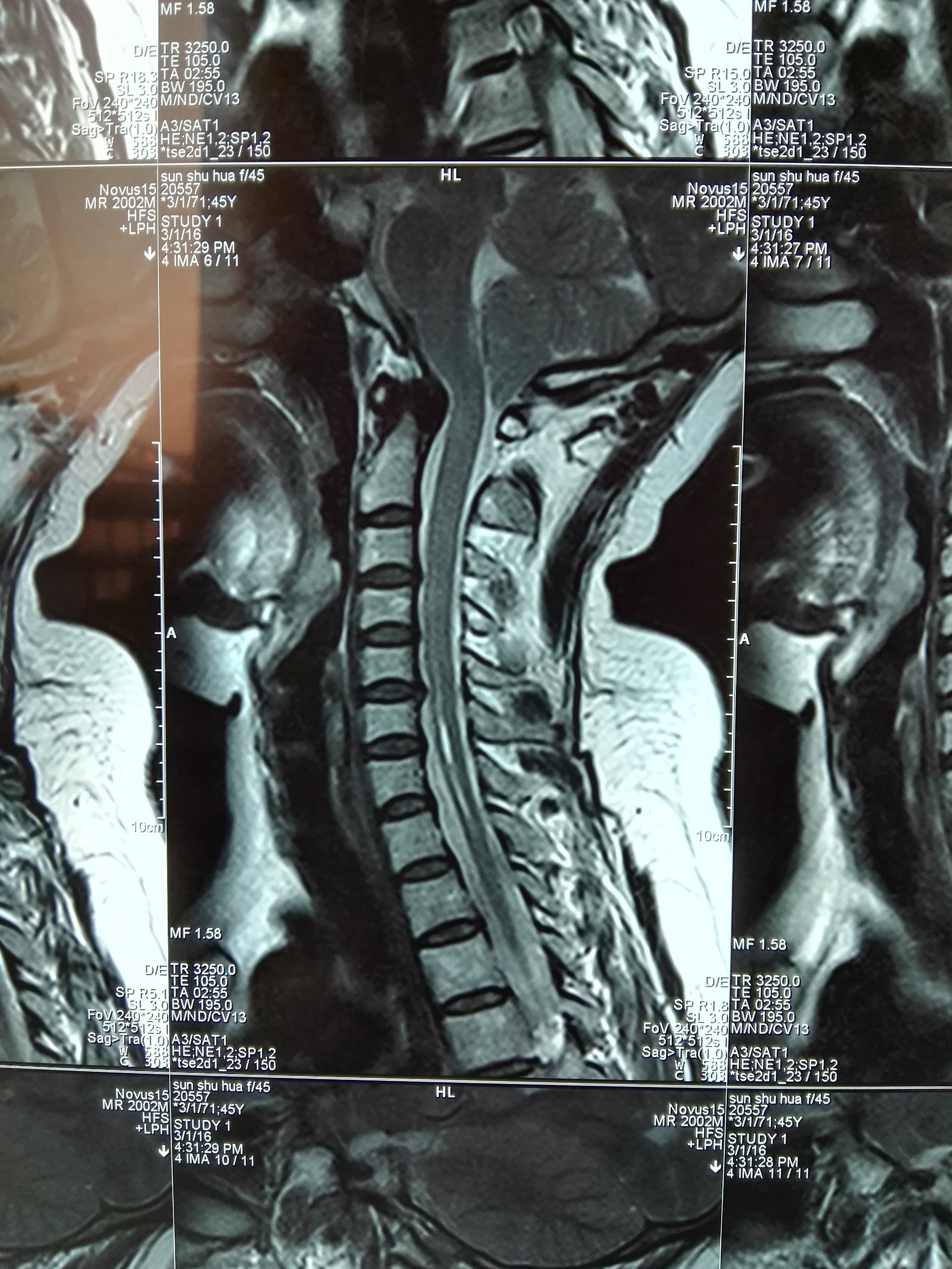脊髓空洞症专业科普