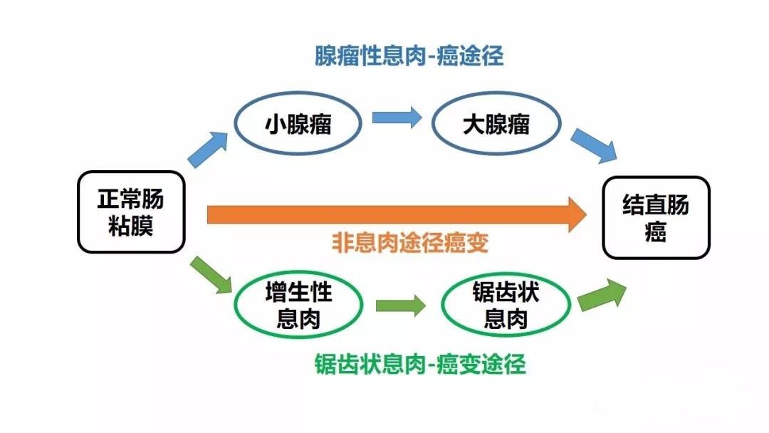 鋸齒狀病變至癌途徑(30%-35%),基本過程為【增生性息肉→鋸齒狀腺瘤