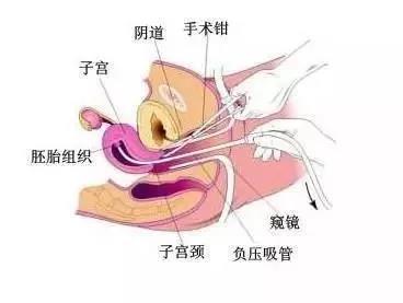 深扒宫腔粘连