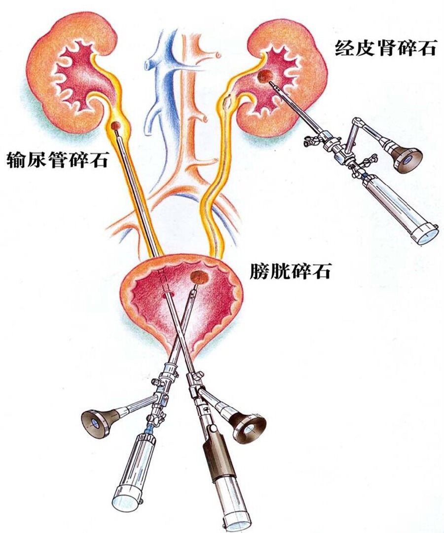 输尿管软镜,肾输尿管结石的利器 