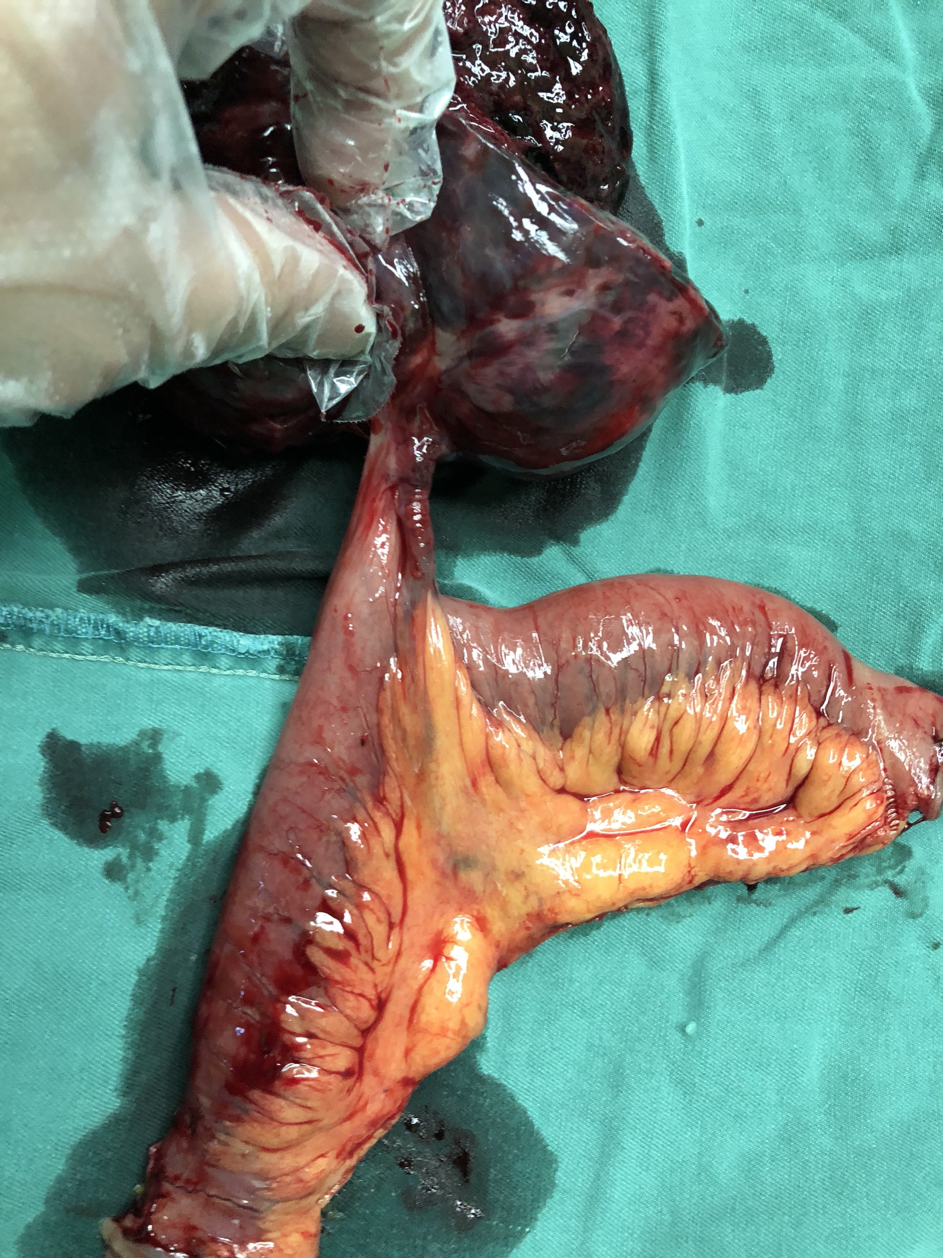 小肠间质瘤破裂出血1例 
