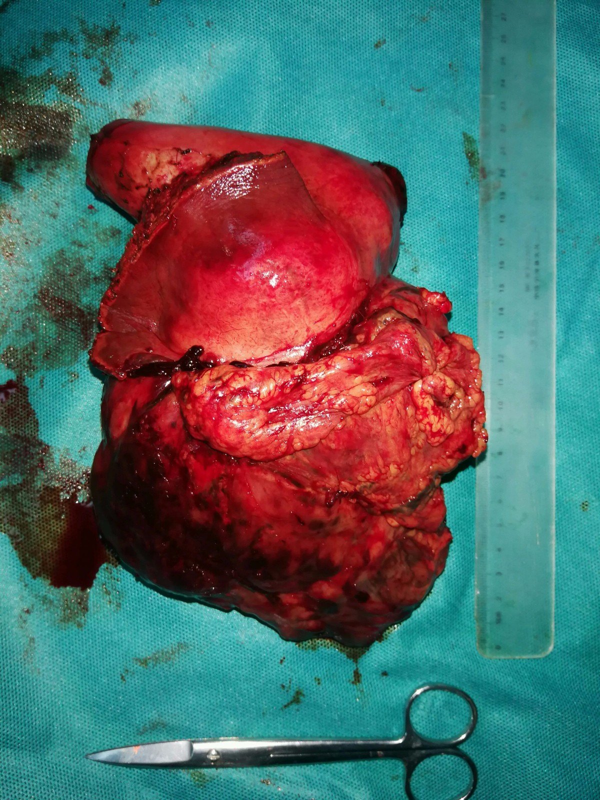 每周诊疗笔记之右上腹腔内巨大肿物 - 好大夫在线