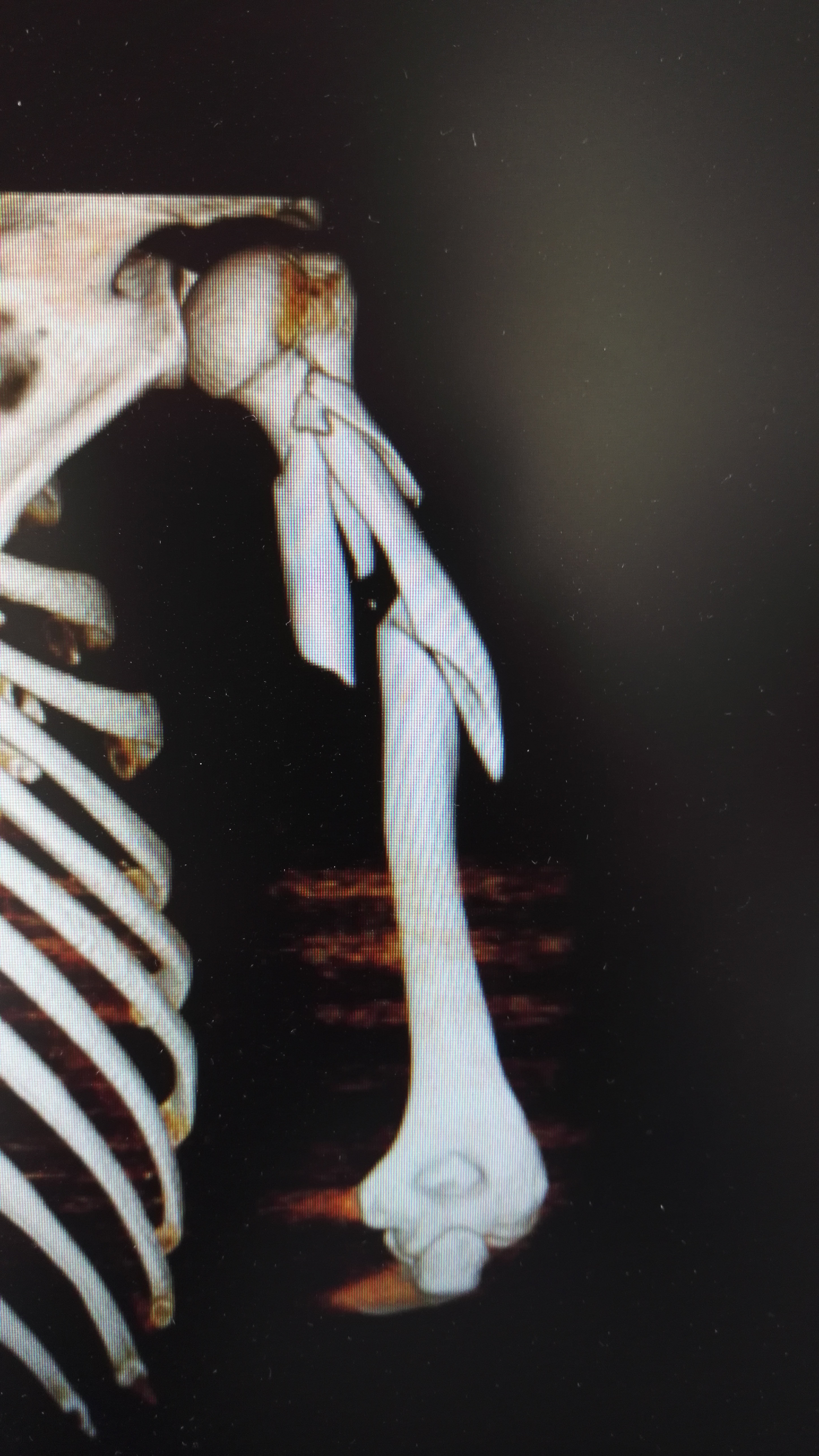 肱骨粉碎性骨折图片图片