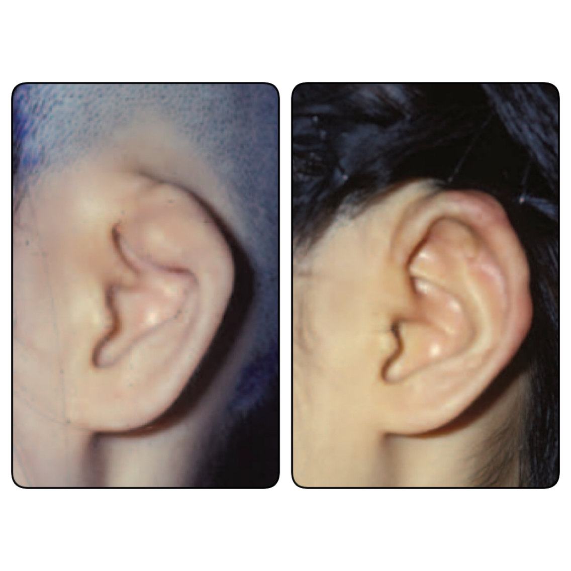 杯状耳卷曲耳完美手术图解附案例八大处于晓波医生