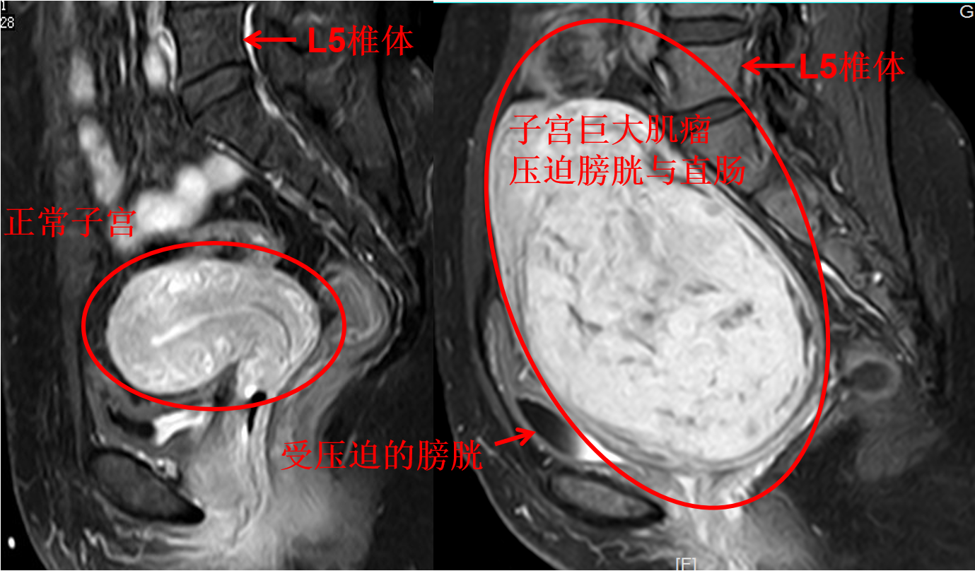 子宫肌瘤引起大姨妈驾到时排山倒海,淋沥不净 